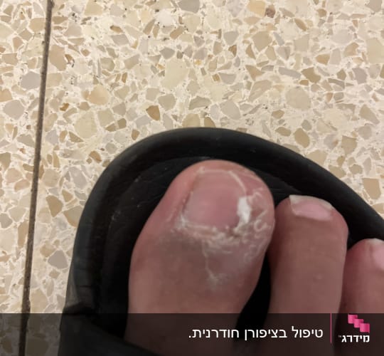 בוהן כף רגל עם עור מתקלף ונגע מסביב לציפורן לפני טיפול פדיקור